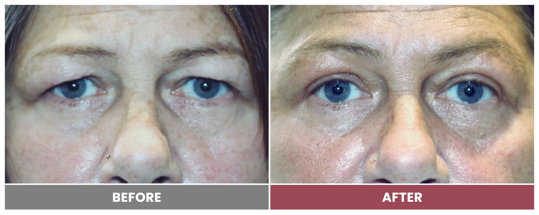 Upper Blepharoplasty - Case 3